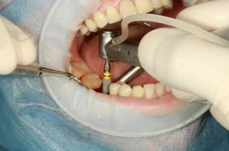 Ar dantų implantai leidžia lengvai kramtyti?